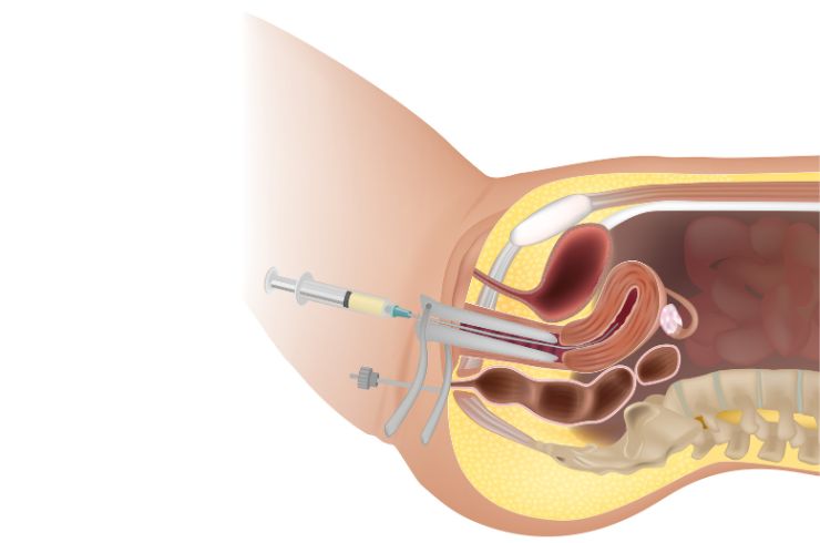 Intrauterine Insemination