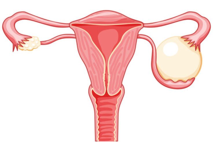 Ovarian Cyst Aspiration