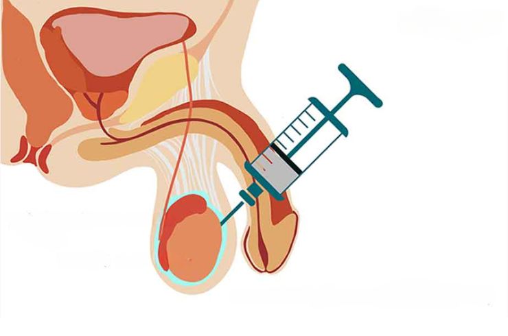 Testicular Sperm Aspiration