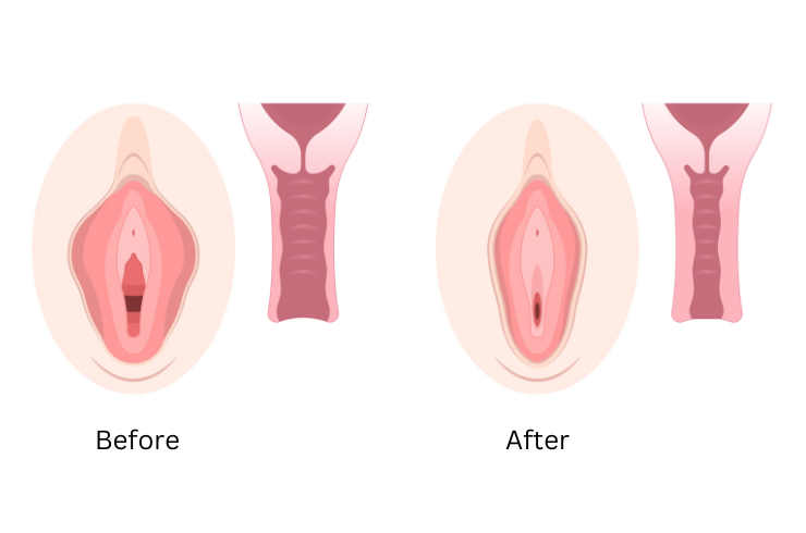 Vaginal Tightening